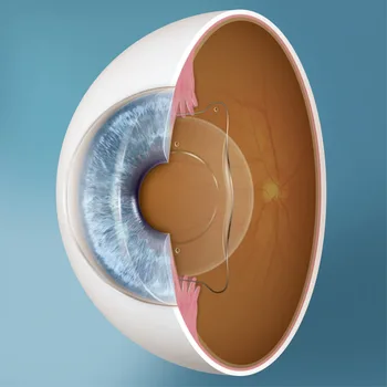 ICL Surgery (Implantable Collamer Lens)